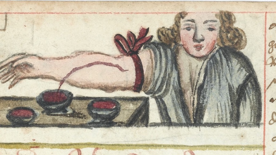Bloodletting was a common 18th-century medical practice to “balance” health.