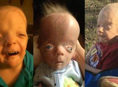 Tragic Story of Grayson Kole Smith - Boy With Rare Birth Defects, Syndrome Named After Him